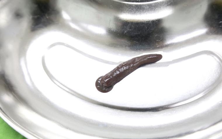 Dia trau dai 10 cm song nhieu ngay trong co hong benh nhan hinh anh