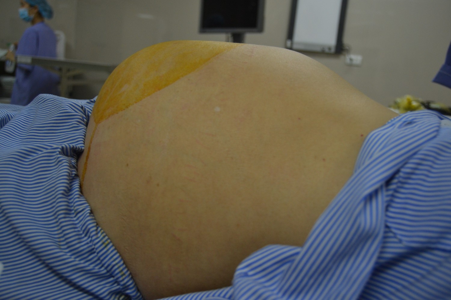 u buồng trứng 6 kg ảnh 1 u buong trung 6 kg anh 1
