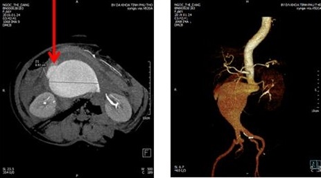 vo phinh dong mach chu bung anh 1