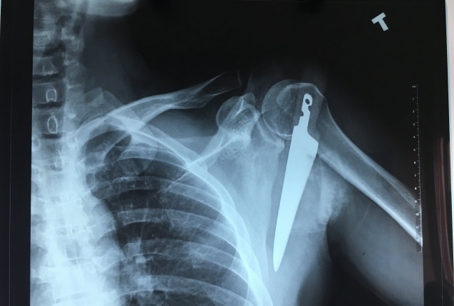 gao đâm vào vai ảnh 1 gao dam vao vai anh 1