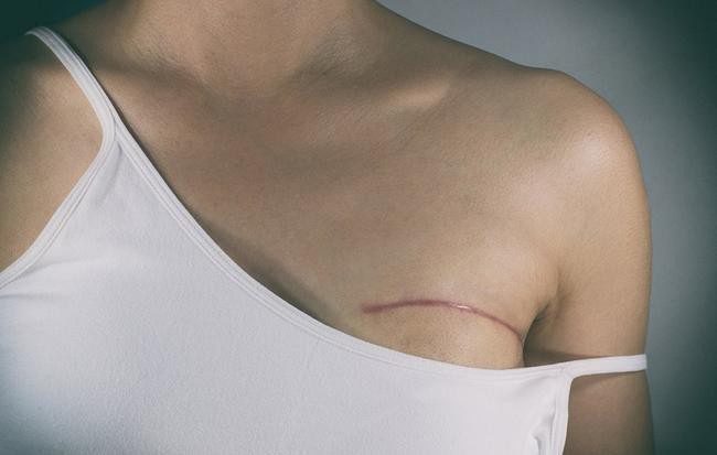 Bệnh ung thư vú ảnh 6 Benh ung thu vu anh 6