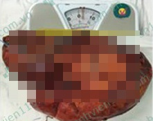 U thân kích thước lớn ảnh 1 U than kich thuoc lon anh 1