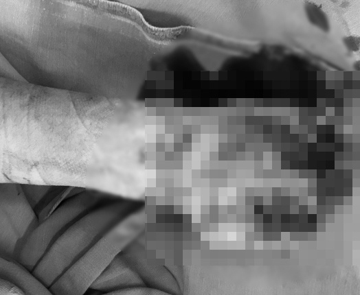 Dập nát bàn tay do dùng điện thoại đang sạc ảnh 1 Dap nat ban tay do dung dien thoai dang sac anh 1