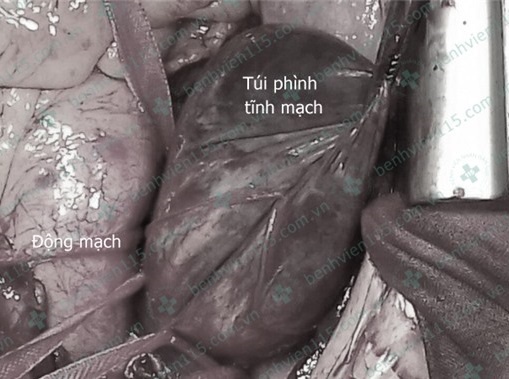 Phình độc mạch chủ ảnh 1 Phinh doc mach chu anh 1