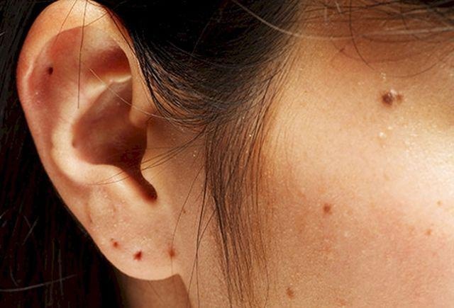 Lưu ý khi tẩy nốt ruồi ảnh 4 Luu y khi tay not ruoi anh 4
