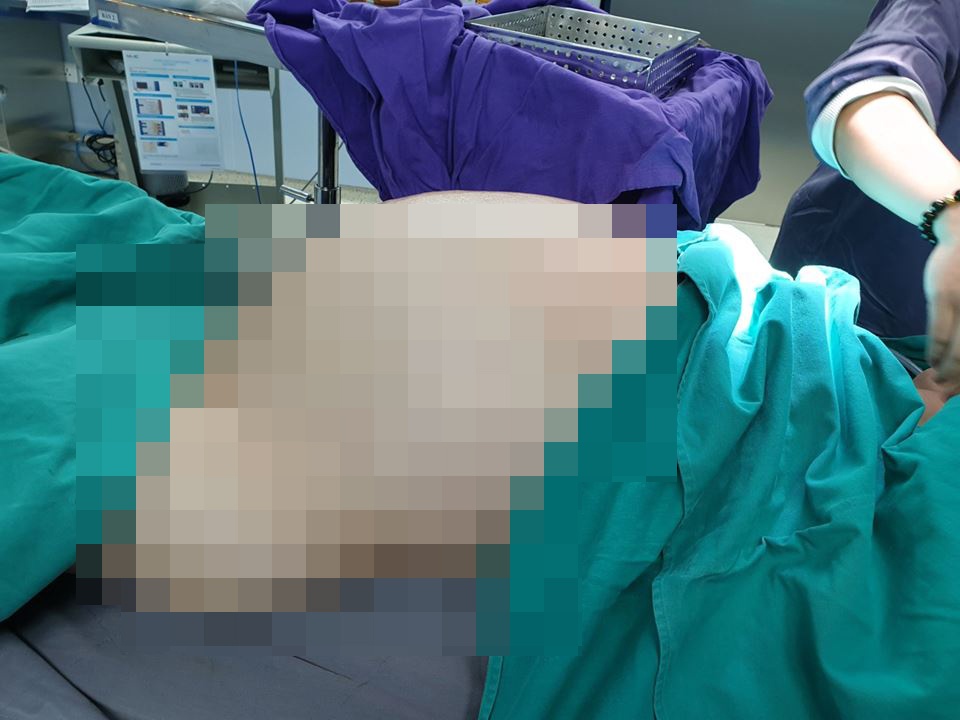 Khối u 25 kg ảnh 1 Khoi u 25 kg anh 1