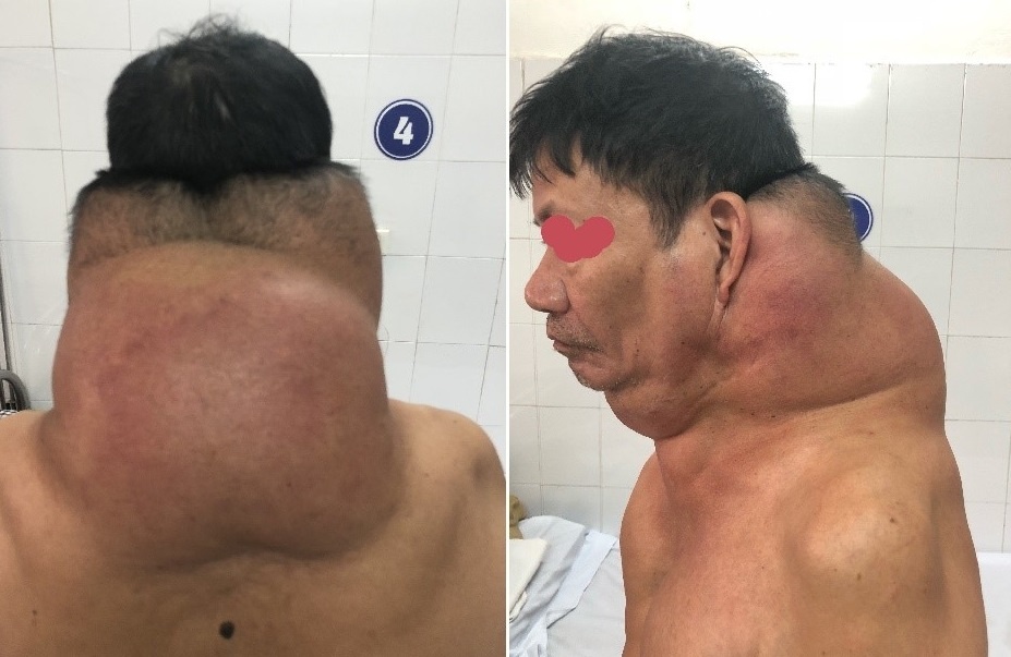 cắt bỏ khối 5 gần 5 kg ảnh 1 cat bo khoi 5 gan 5 kg anh 1