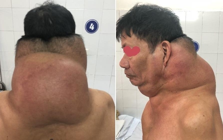 Phau thuat thanh cong khoi u gan 5 kg cho 'nguoi gau' hinh anh