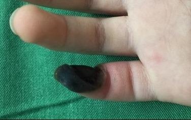 Be gai hoai tu ngon tay vi tu chua mun coc bang thuoc mua tren mang hinh anh