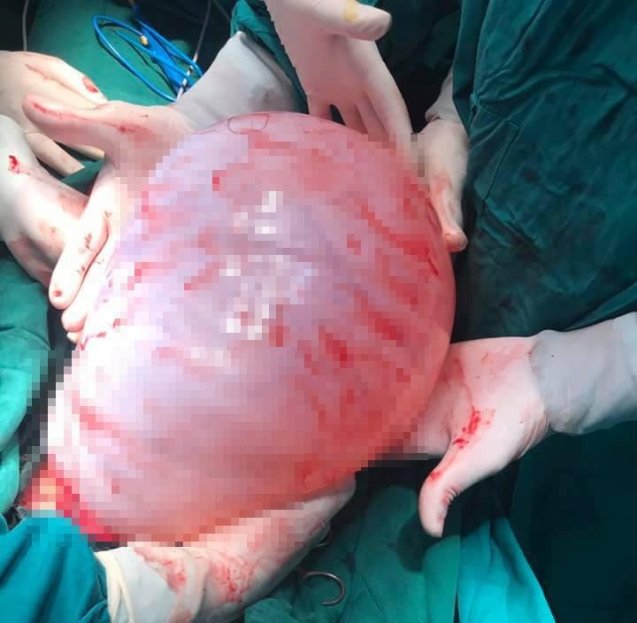 Khối u buồng trứng 8 kg ảnh 1 Khoi u buong trung 8 kg anh 1