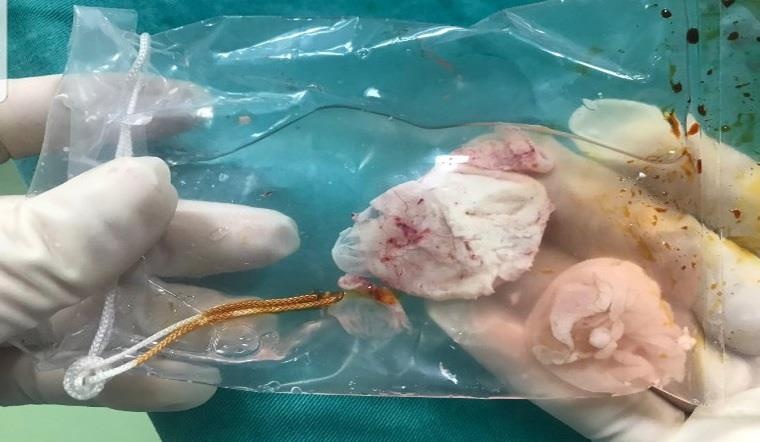 ổ sán khổng lồ trong não ảnh 1 o san khong lo trong nao anh 1