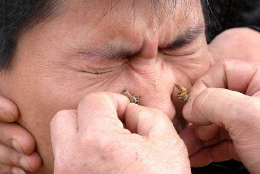 Nhoi mau co tim sau khi bi ong dot hinh anh