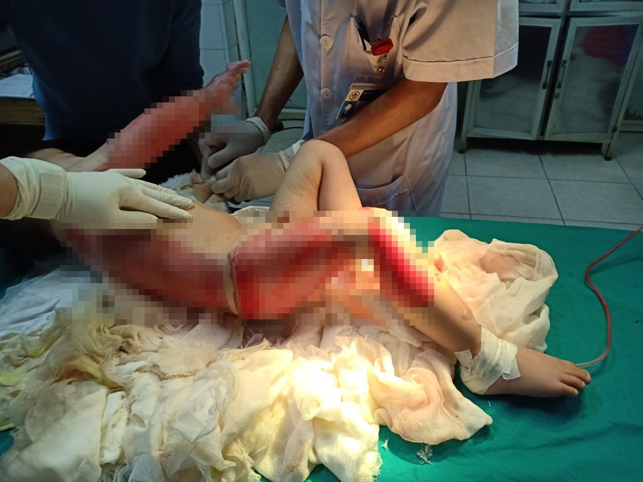 Bỏng nước sôi ở trẻ ảnh 1 Bong nuoc soi o tre anh 1