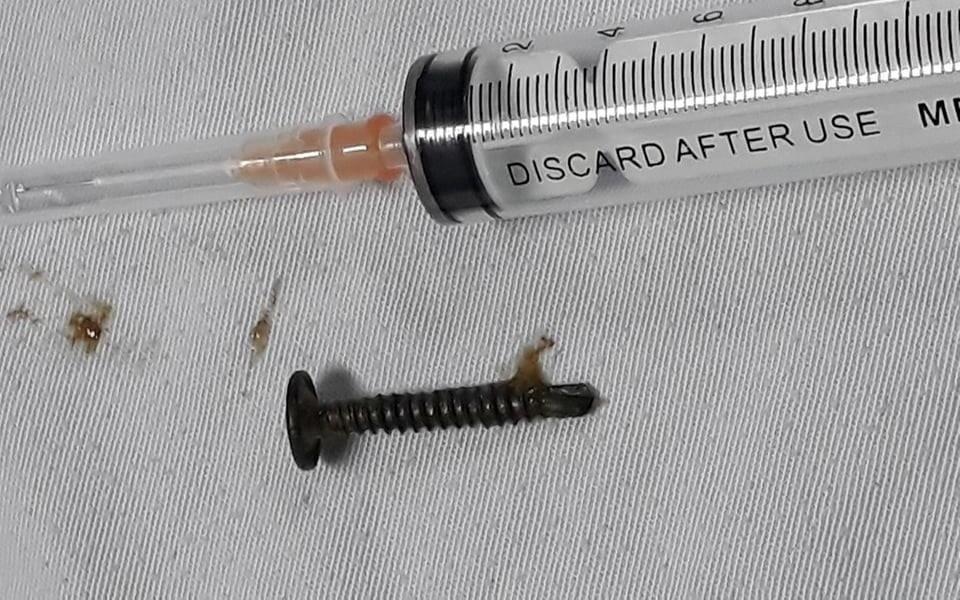 Gap dinh vit ra khoi thuc quan benh nhi 5 tuoi hinh anh