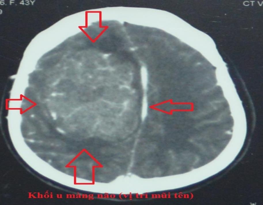 u mang nao khong lo anh 1