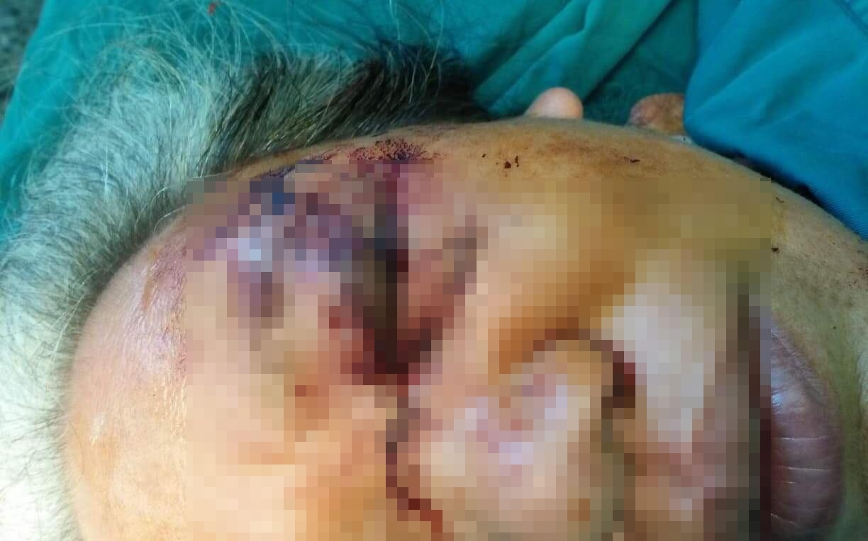 trâu húc nát vùng mắt ảnh 1 trau huc nat vung mat anh 1