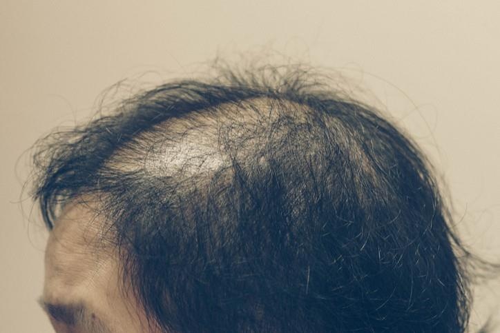 Chân tóc đầy mủ sau khi cấy tóc ảnh 1 Chan toc day mu sau khi cay toc anh 1