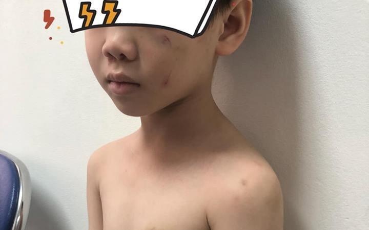 Lam ro nghi van hoc sinh lop 1 bi me ke bao hanh hinh anh