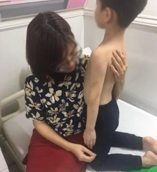Học sinh lớp 1 bị mẹ kế bạo hành ảnh 1 Hoc sinh lop 1 bi me ke bao hanh anh 1