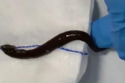 đỉa trâu trong cổ họng ảnh 1 dia trau trong co hong anh 1