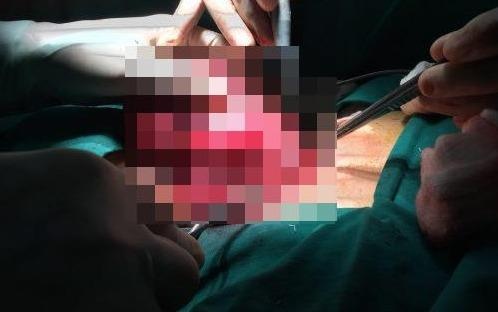 Cat khoi u tuyen giap khong lo tren co benh nhan hinh anh