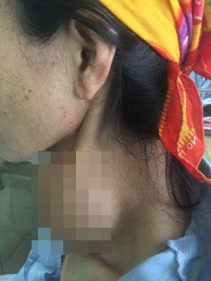 cắt khối u tuyến giáp khổng lồ ảnh 1 cat khoi u tuyen giap khong lo anh 1
