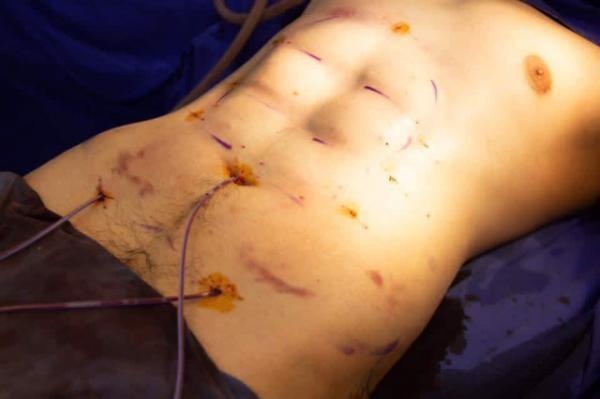 phẫu thuật tạo cơ bụng 6 múi ảnh 1 phau thuat tao co bung 6 mui anh 1