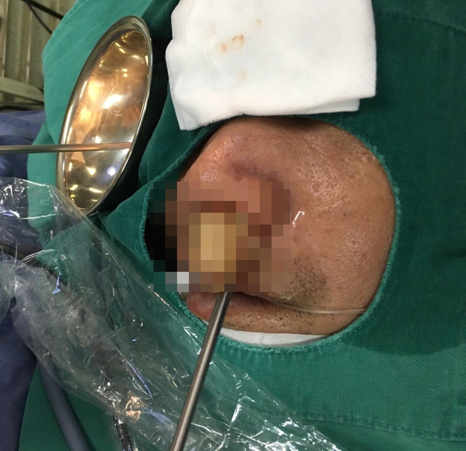 Benh nhan kho tho vi khoi u anh 1