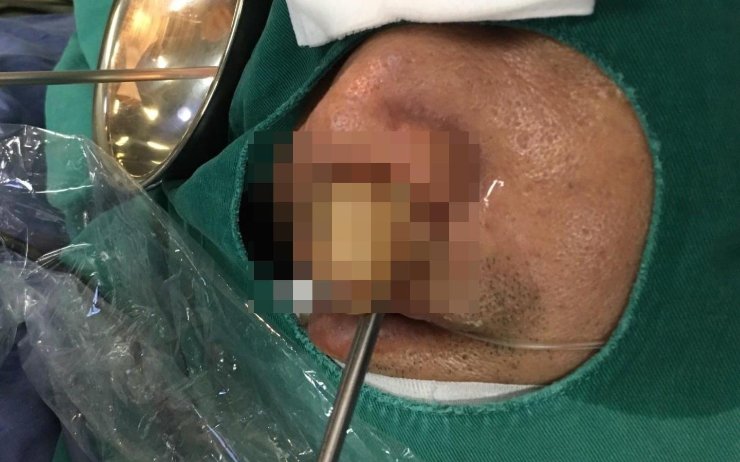 Benh nhan kho tho, khong ngui duoc suot 10 nam vi khoi u trong mui hinh anh