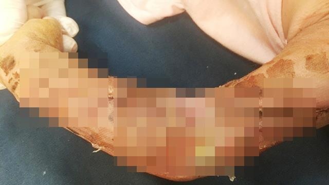 Xe tải tông bé trai dập cánh tay ảnh 1 Xe tai tong be trai dap canh tay anh 1