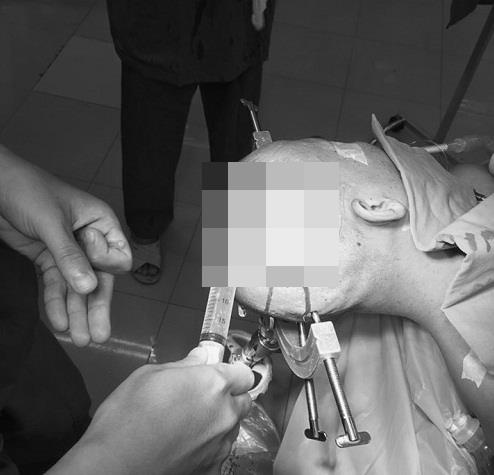 Bệnh u não ảnh 1 Benh u nao anh 1