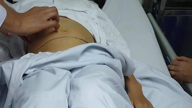 u quái buồng trứng ảnh 1 u quai buong trung anh 1