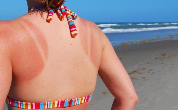 xử trí khi da cháy nắng ảnh 4 xu tri khi da chay nang anh 4