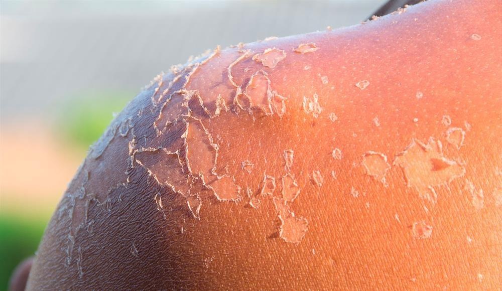 xử trí khi da cháy nắng ảnh 8 xu tri khi da chay nang anh 8