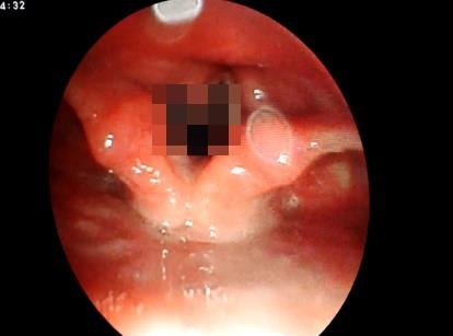 Đỉa dài 5 cm sống bám trong khí quản ảnh 1 Dia dai 5 cm song bam trong khi quan anh 1