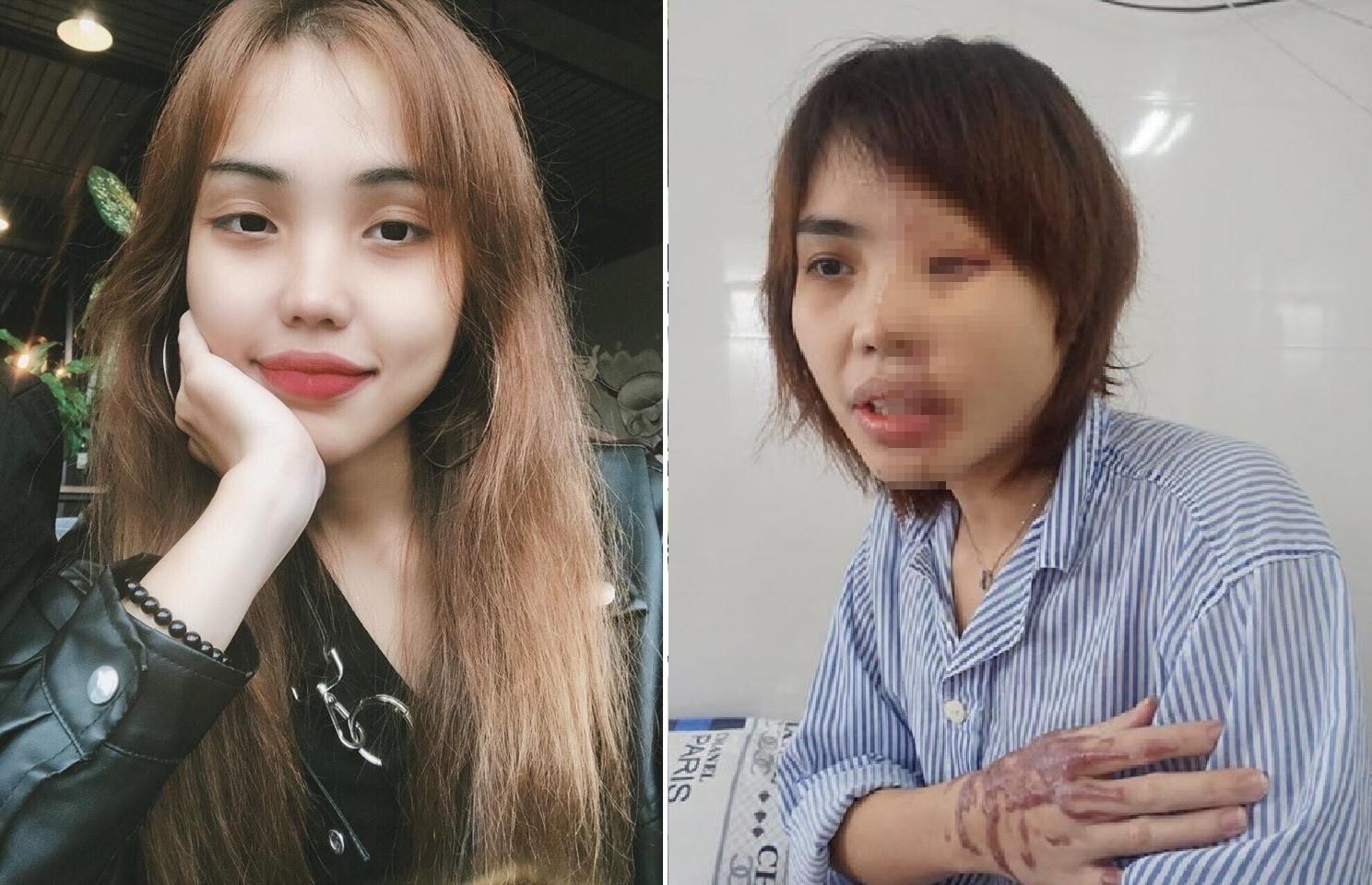 cô gái bị chồng sắp cưới tạt axit ảnh 2 co gai bi chong sap cuoi tat axit anh 2