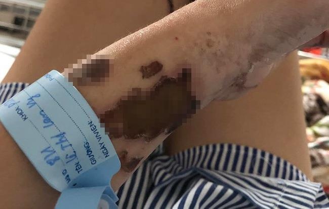 cô gái bị chồng sắp cưới tạt axit ảnh 1 co gai bi chong sap cuoi tat axit anh 1