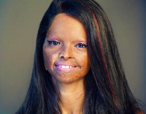 15 tuoi bi tat axit va hanh trinh tro thanh nguoi noi tieng o An Do hinh anh