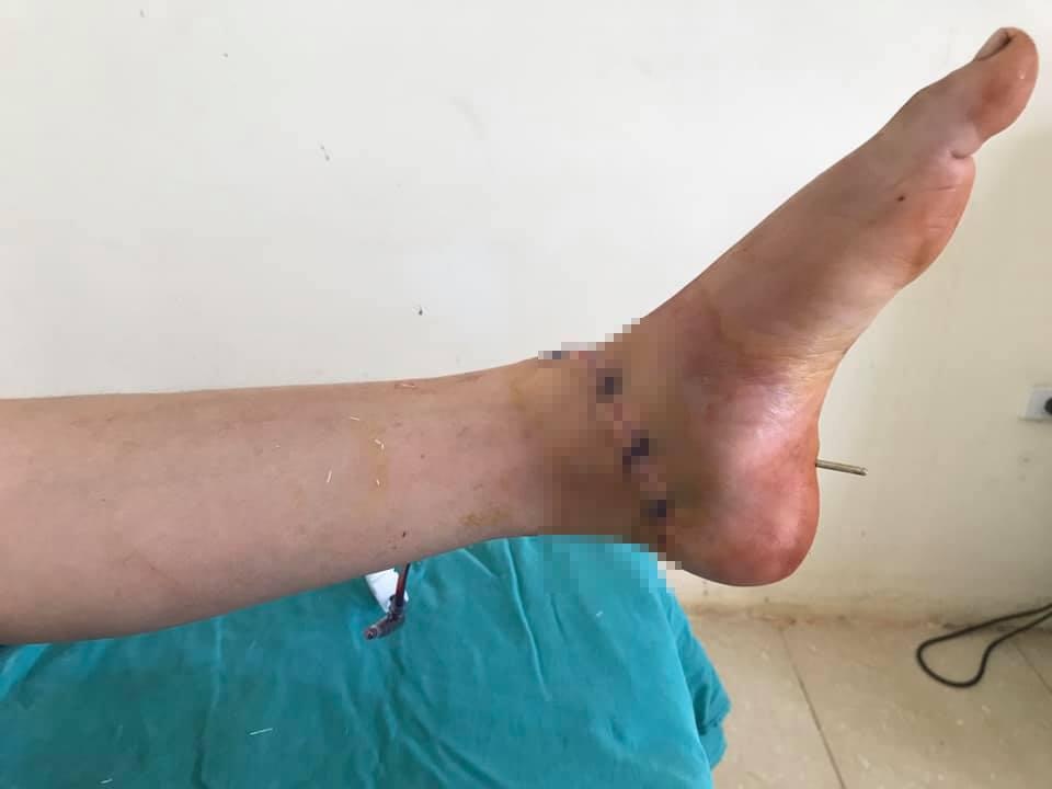 Nối cổ chân đứt lìa  ảnh 1 Noi co chan dut lia anh 1