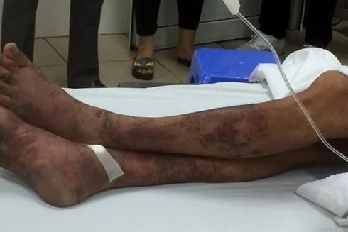 Mo lon chet lam com, nguoi dan ong 48 tuoi mat mang hinh anh