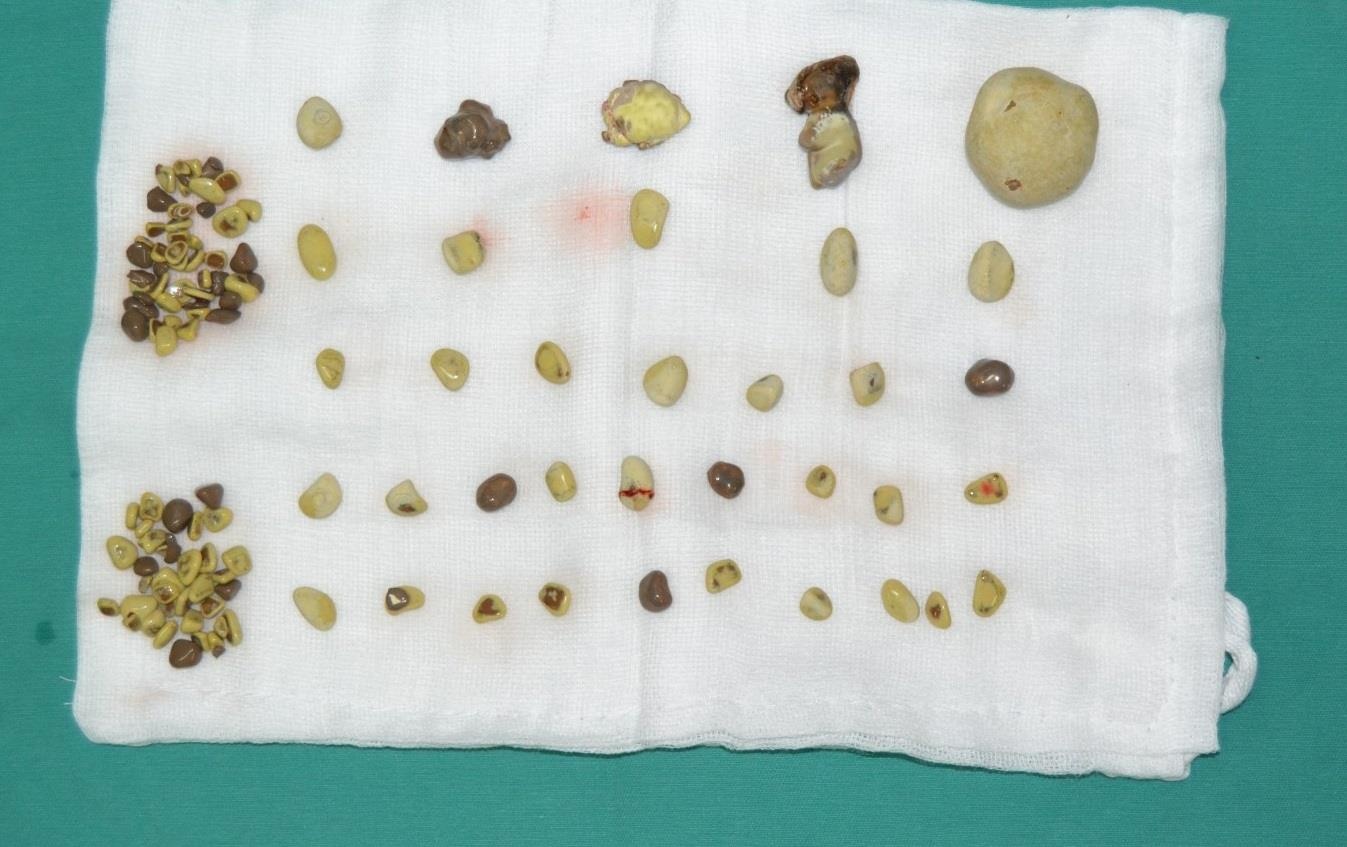 Phẫu thuật lấy hơn 100 viên sỏi trong thận ảnh 1 Phau thuat lay hon 100 vien soi trong than anh 1