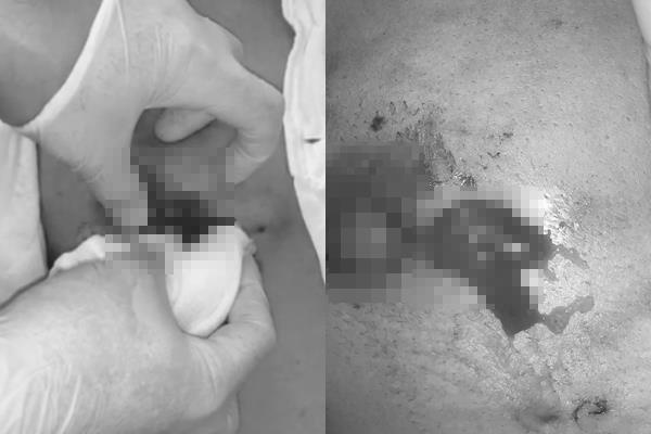 ngực chảy mủ vf tiêm filler ảnh 1 nguc chay mu vf tiem filler anh 1