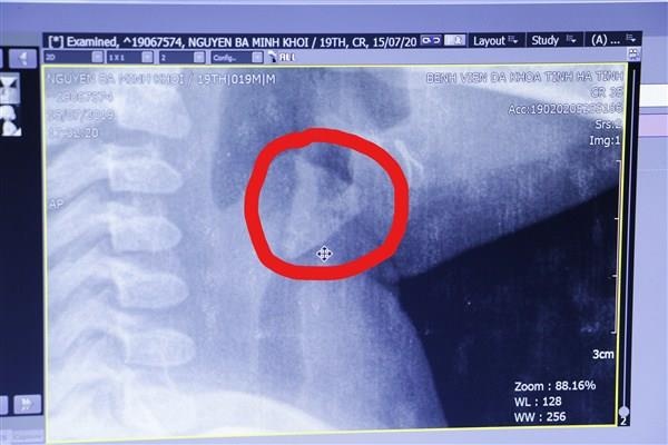 be trai hoc xuong suyt chet anh 1