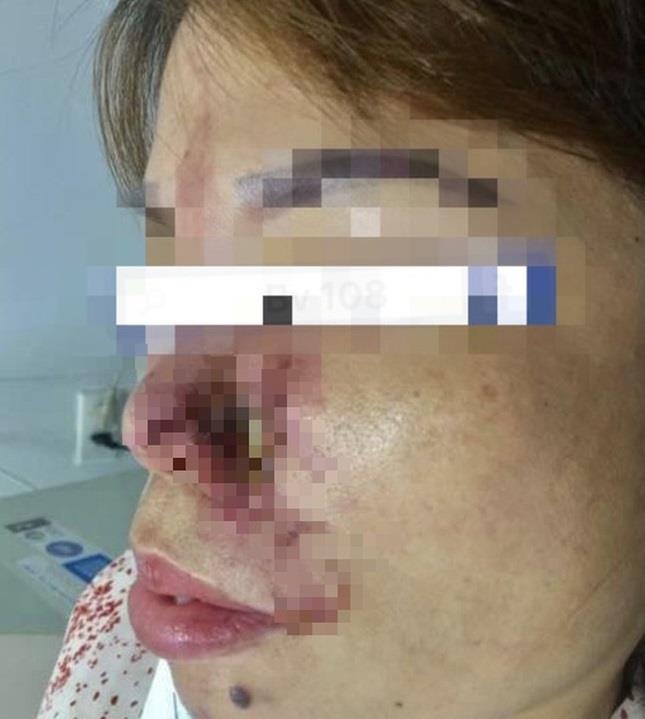 Hoại tử mũi sau tiêm filler ảnh 1 Hoai tu mui sau tiem filler anh 1