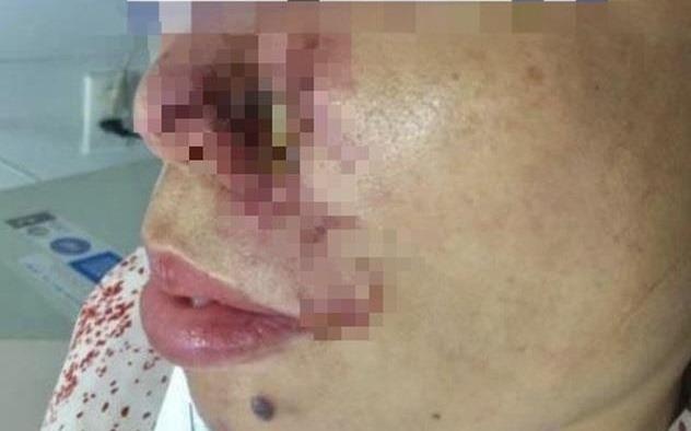 Mui co gai mung mu, hoai tu sau tiem filler lam dep hinh anh