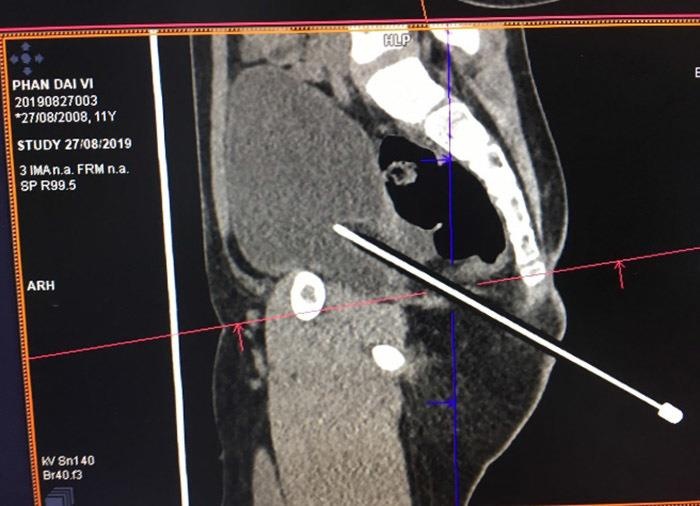 bé trai bị bút đâm thấu bụng ảnh 1 be trai bi but dam thau bung anh 1