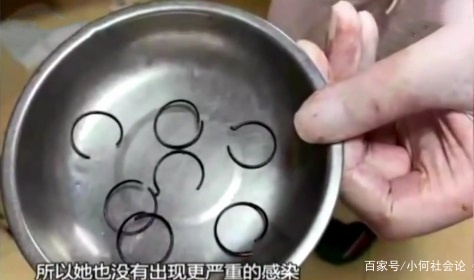 Đặt lò xo tránh thai ảnh 2 Dat lo xo tranh thai anh 2