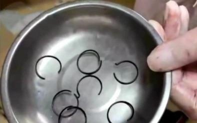 Nguoi phu nu nhet lo xo vao vung kin de tranh thai hinh anh