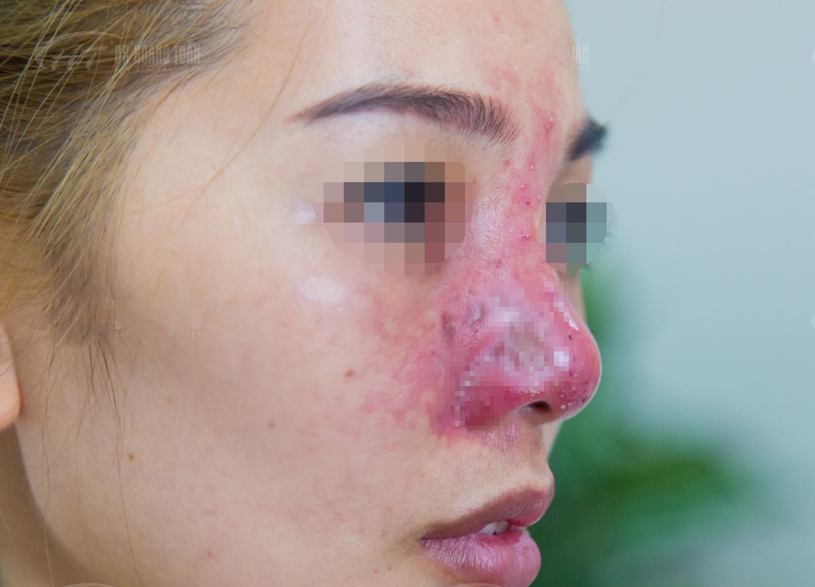 suýt mất mũi vì tiêm filler ảnh 1 suyt mat mui vi tiem filler anh 1