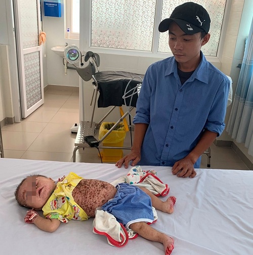 Bé mắc viêm da tiết bã bội nhiễm ảnh 1 Be mac viem da tiet ba boi nhiem anh 1